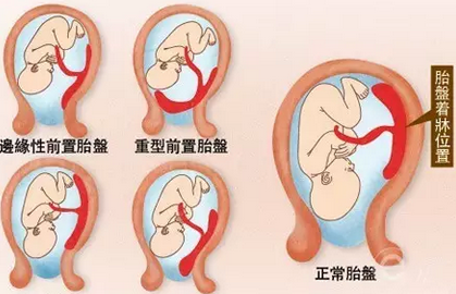 胎盘低是怎么回事 胎盘低怎么办